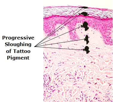 Sloughing of tattoo pigment