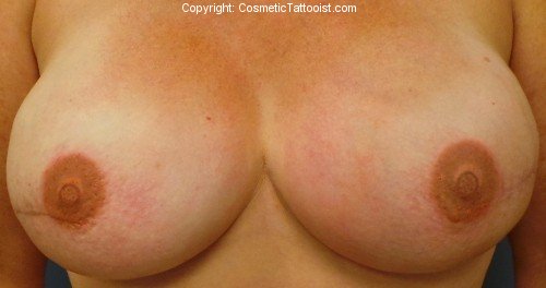 Breast Reconstruction After 3D Areola Tattooing