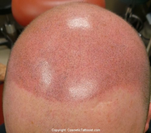 Scalp Tattooing Immediately After First Treatment