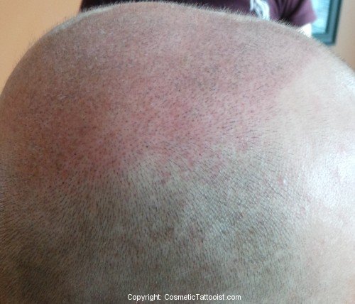 Scalp Tattooing Side View Immediately After First Treatment