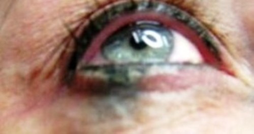 Eyeliner Pigment Migration - Bruising & Bleeding