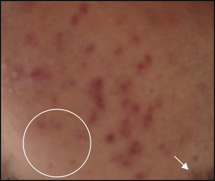 PIH Caused by Acne