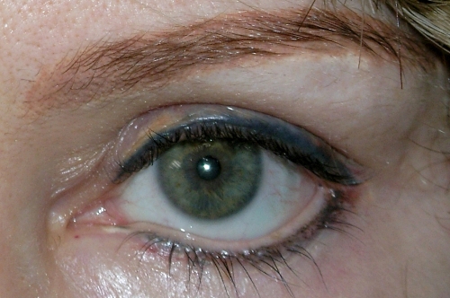 Eyeliner Tattoo - Corrections with Skin Coloured Pigment