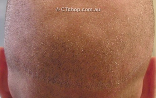 Hair Transplant Scar After Tattooing