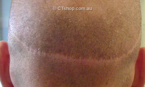 Hair Transplant Scar Before Tattooing